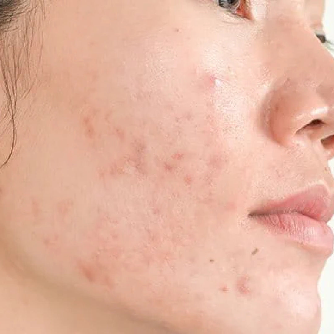 acne-blemish-control