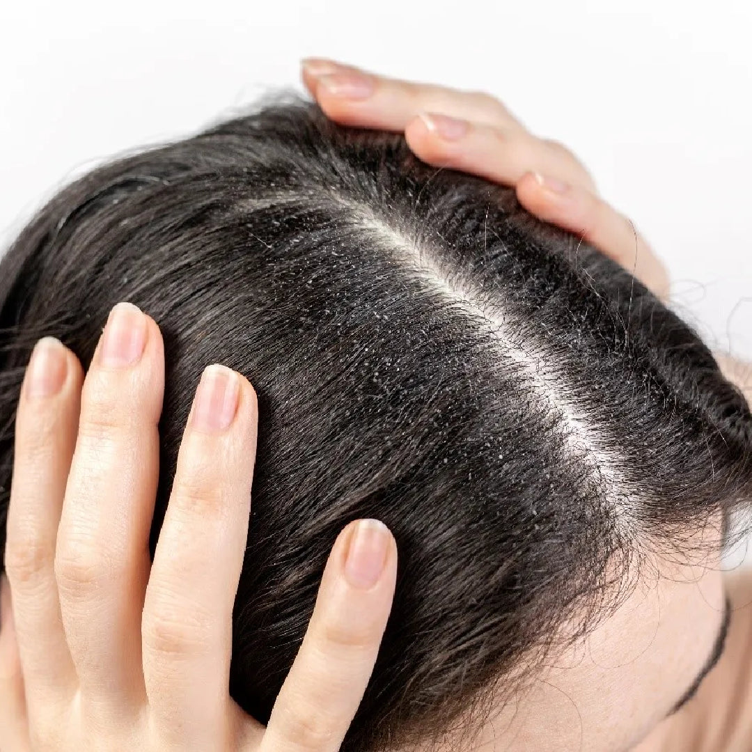 dandruff-scalp-care